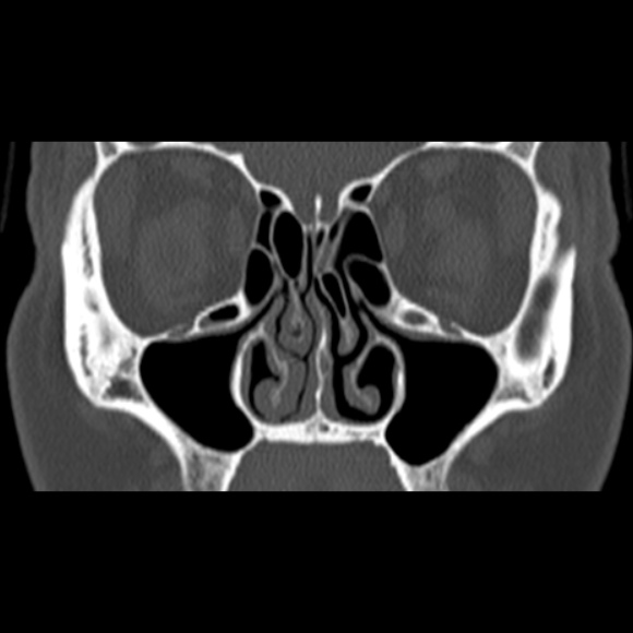 Nasal septal perforation (Radiopaedia 25030-25289 Coronal bone window 31).jpg
