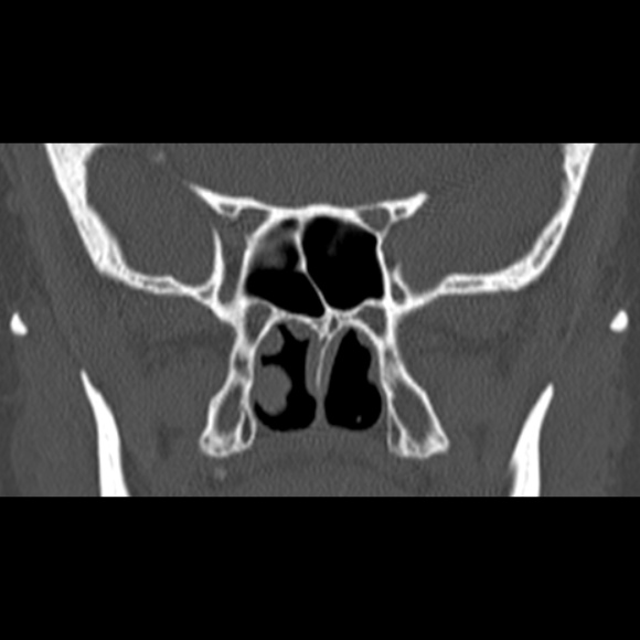 Nasal septal perforation (Radiopaedia 25030-25289 Coronal bone window 52).jpg