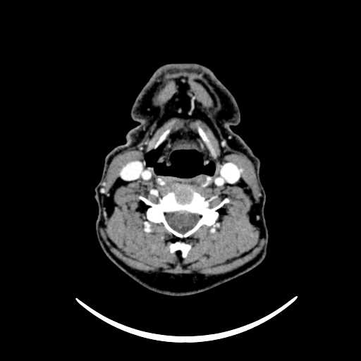 File:Nasopharyngeal carcinoma - infiltrating the clivus (Radiopaedia 62583-70875 Axial Post contrast 48).jpg