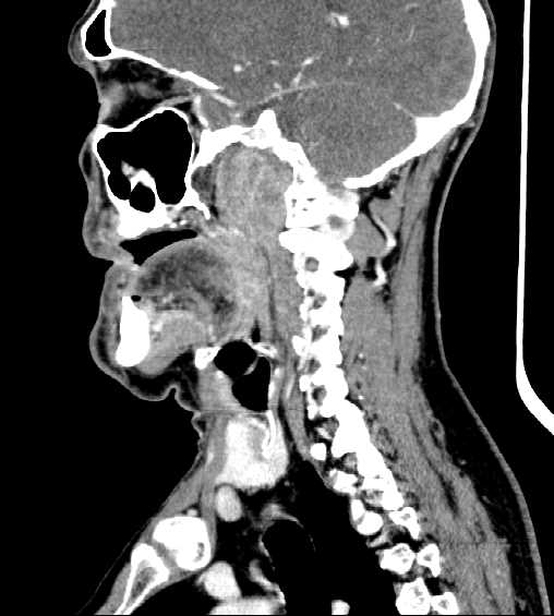 File:Nasopharyngeal carcinoma - infiltrating the clivus (Radiopaedia 62583-70875 C 21).jpg