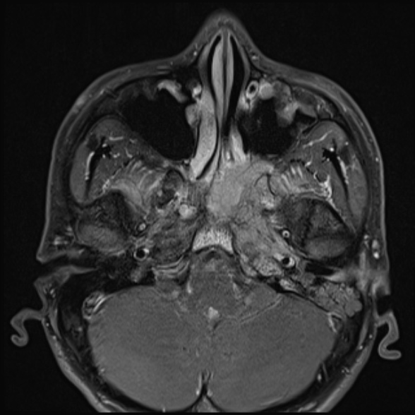 Nasopharyngeal carcinoma with skull base invasion (Radiopaedia 53415-59485 Axial T1 C+ fat sat 23).jpg
