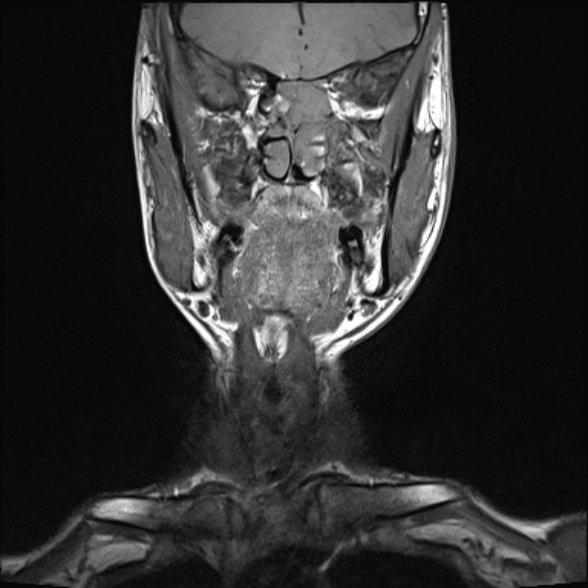 Nasopharyngeal carcinoma with skull base invasion (Radiopaedia 53415-59485 Coronal T1 27).jpg