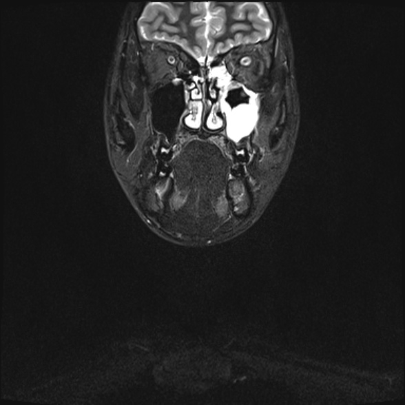 Nasopharyngeal carcinoma with skull base invasion (Radiopaedia 53415-59485 Coronal T2 fat sat 32).jpg
