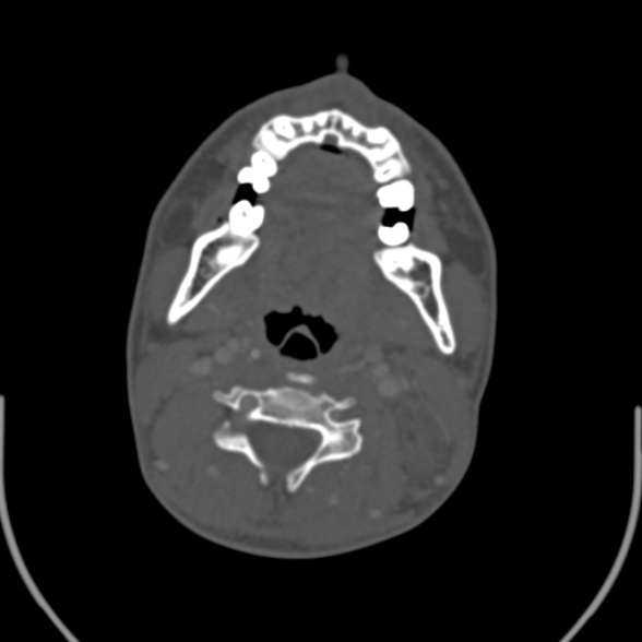 Nasopharyngeal carcinoma with skull base invasion (Radiopaedia 53415-59705 Axial bone window 104).jpg
