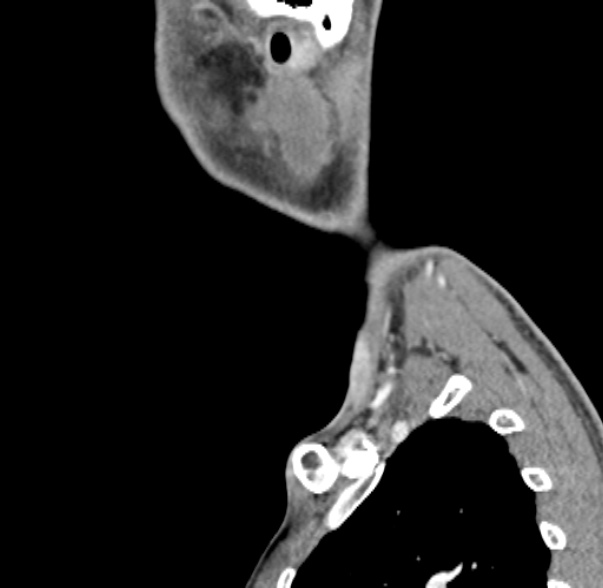 File:Nasopharyngeal carcinoma with skull base invasion (Radiopaedia 53415-59705 C 5).jpg