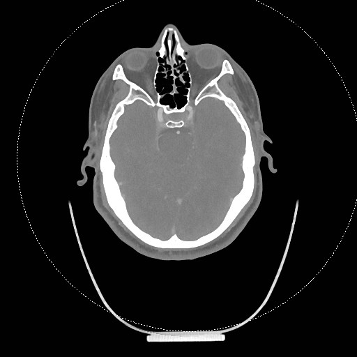 Neck CT angiogram (intraosseous vascular access) (Radiopaedia 55481-61945 B 287).jpg