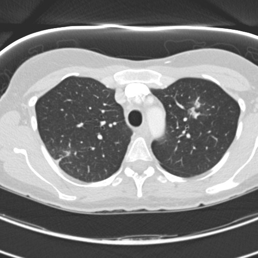Necrobiotic pulmonary nodules - Crohn disease (Radiopaedia 20723-20631 Axial lung window 39).jpg