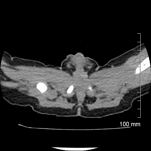 File:Neonatal neuroblastoma (Radiopaedia 56651-63438 Axial non-contrast 86).jpg