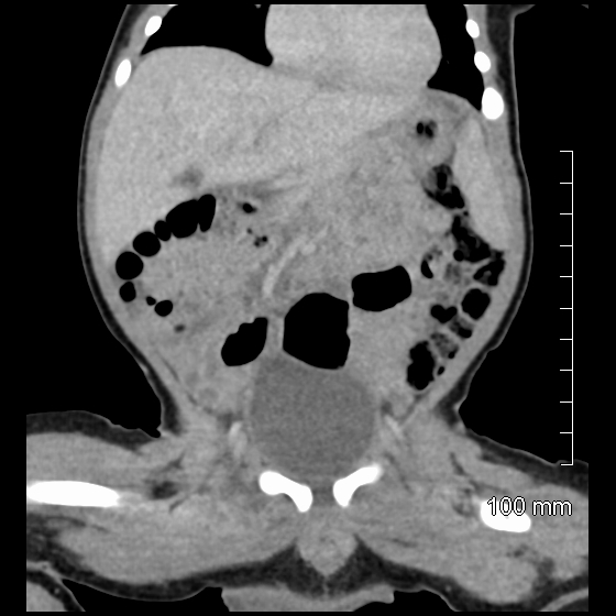File:Neonatal neuroblastoma (Radiopaedia 56651-63438 Coronal non-contrast 22).jpg