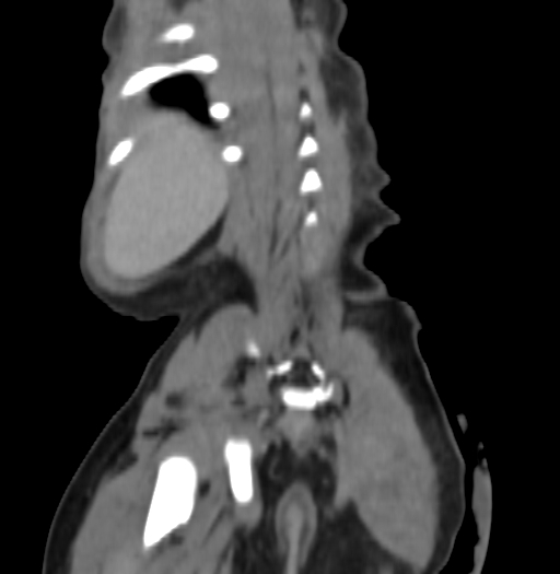 Nephroblastomatosis (Radiopaedia 71294-81607 B 284).jpg