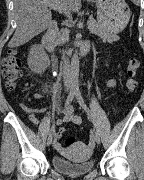 File:Nephrostomy for urosepsis (Radiopaedia 26180-26330 non-contrast 46).jpg