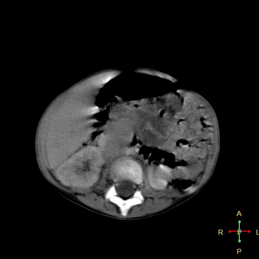 File:Neuroblastoma (Radiopaedia 24751-25016 D 21).jpg