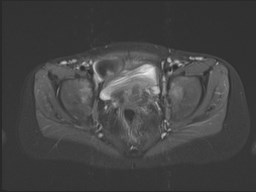 File:Neuroblastoma with bone metastases (Radiopaedia 67080-76414 Axial STIR 50).jpg