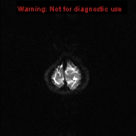 File:Neurofibromatosis type 1 with optic nerve glioma (Radiopaedia 16288-15965 Axial DWI 1).jpg