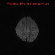 File:Neurofibromatosis type 1 with optic nerve glioma (Radiopaedia 16288-15965 Axial DWI 53).jpg