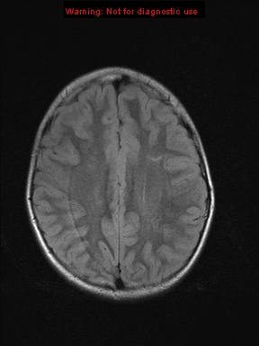 File:Neurofibromatosis type 1 with optic nerve glioma (Radiopaedia 16288-15965 Axial FLAIR 8).jpg