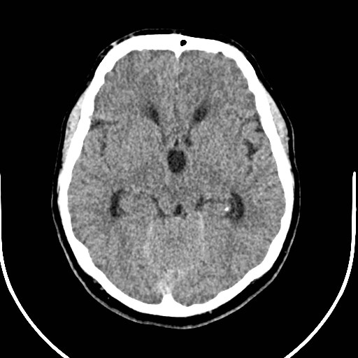 Neurofibromatosis type 2 (Radiopaedia 79097-92047 Axial non-contrast 26).jpg