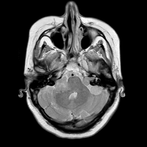 File:Neurofibromatosis type 2 (Radiopaedia 8713-9518 Axial Gradient Echo 19).jpg