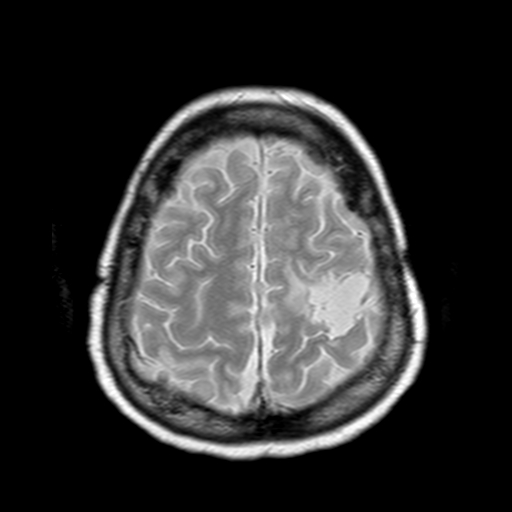 File:Neurofibromatosis type 2 (Radiopaedia 8713-9518 Axial Gradient Echo 5).jpg