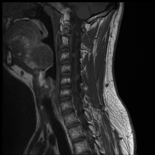 File:Neurofibromatosis type 2 (spinal manifestations) (Radiopaedia 53943-60070 Sagittal T1 8).png