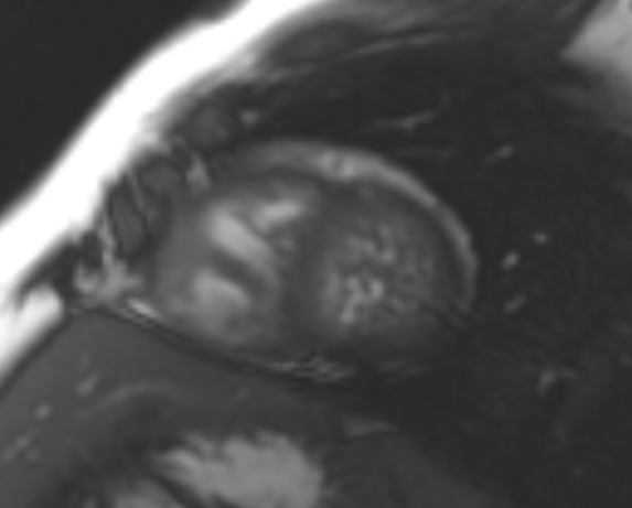 File:Non-compaction of the left ventricle (Radiopaedia 69436-79314 Short axis cine 64).jpg