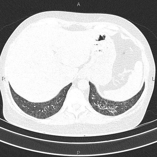 Non-specific interstitial pneumonia (Radiopaedia 83185-97567 Axial lung window 56).jpg