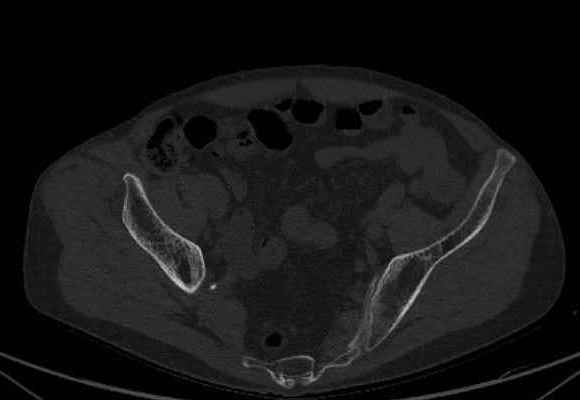 File:Nondisplaced incomplete intertrochanteric fracture (Radiopaedia 73736-84539 Axial bone window 4).jpg