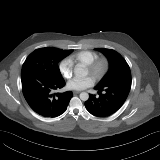 File:Normal CTA thorax (non ECG gated) (Radiopaedia 41750-44704 A 55).png