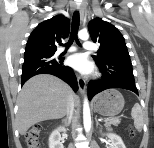 File:Normal CTA thorax (non ECG gated) (Radiopaedia 41750-44704 B 50).png
