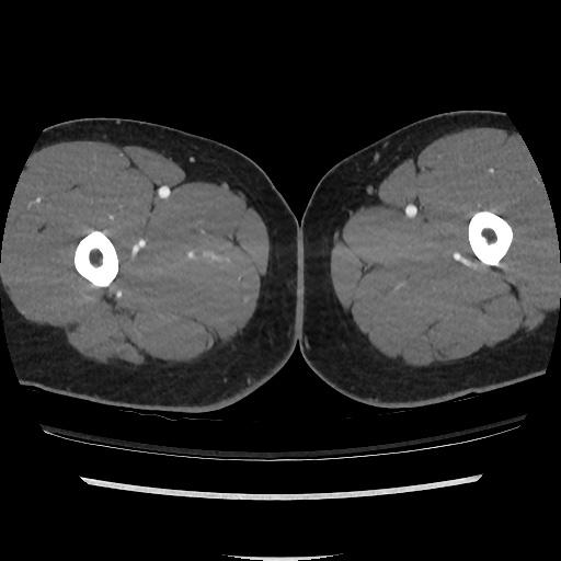 File:Normal CT angiogram of pelvis (Radiopaedia 45390-49430 A 77).jpg
