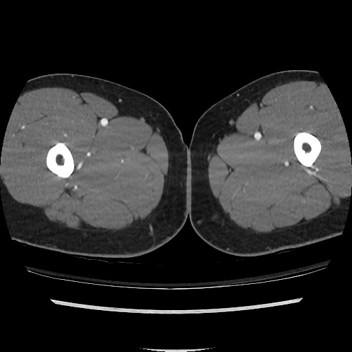 File:Normal CT angiogram of pelvis (Radiopaedia 45390-49430 A 79).jpg