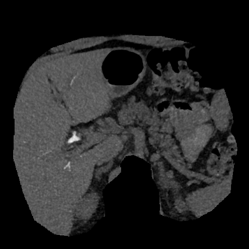 File:Normal CT intravenous cholangiogram (Radiopaedia 38199-40208 Axial IVC (MIP) 52).png