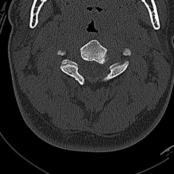 File:Normal CT of the cervical spine (Radiopaedia 53322-59305 Axial bone window 94).jpg