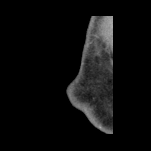 Normal CT paranasal sinuses (Radiopaedia 42286-45390 F 9).jpg
