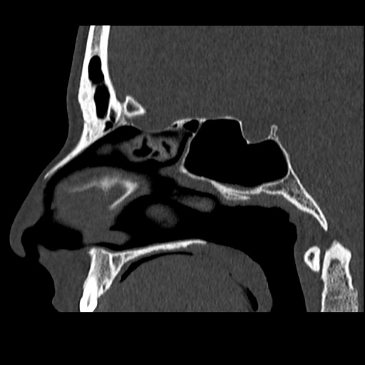 Normal CT paranasal sinuses (Radiopaedia 42286-45390 Sagittal bone window 49).jpg