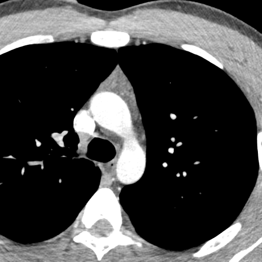 File:Normal CT pulmonary veins (pre RF ablation) (Radiopaedia 41748-44702 A 18).png