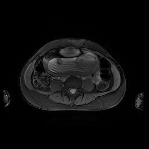 File:Normal MRI abdomen in pregnancy (Radiopaedia 88001-104541 D 33).jpg