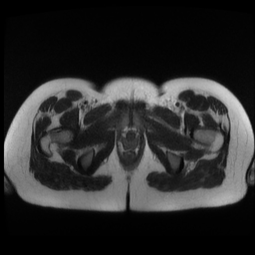 Normal MRI abdomen in pregnancy (Radiopaedia 88003-104546 Axial T2 51).jpg