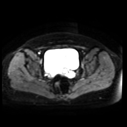 Normal MRI abdomen in pregnancy (Radiopaedia 88005-104548 Axial DWI 16).jpg