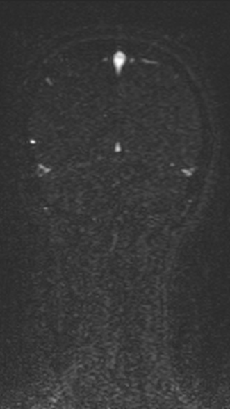 Normal MRI brain with MRV- teenager (Radiopaedia 49425-54553 Coronal MRV 198).jpg