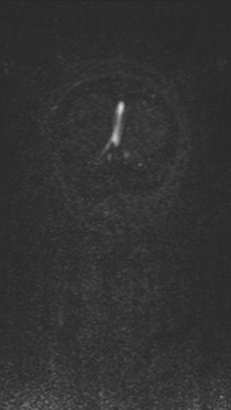 Normal MRI brain with MRV- teenager (Radiopaedia 49425-54553 Coronal MRV 217).jpg