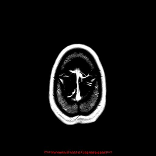Normal adult brain MRI (non-enhanced and contrast-enhanced) (Radiopaedia 75262-86379 Axial T1 C+ 168).jpg