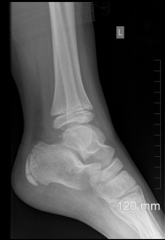 File:Normal ankle x-ray - 11-year-old (Radiopaedia 53474-59477 Lateral 1).png
