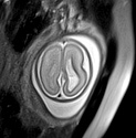 File:Normal brain fetal MRI - 22 weeks (Radiopaedia 50623-56050 Axial T2 Haste 4).jpg