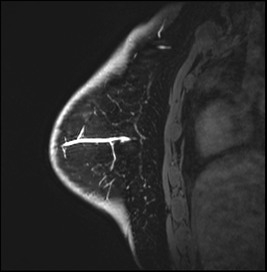 Normal breast MRI - dense breasts (Radiopaedia 80454-93850 I 145).jpg