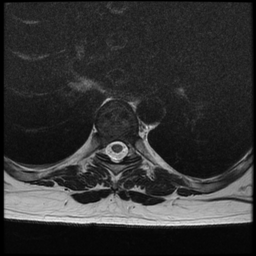 File:Normal cervical and thoracic spine MRI (Radiopaedia 35630-37156 H 24).png