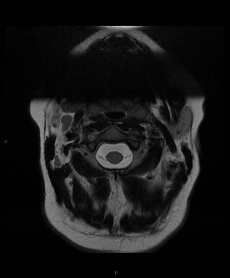 Normal cervical spine MRI (Radiopaedia 80146-93454 Axial T2 2).jpg