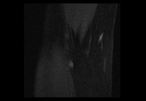 File:Normal elbow arthrograms (Radiopaedia 75550-86805 Coronal T1 fat sat 17).jpg