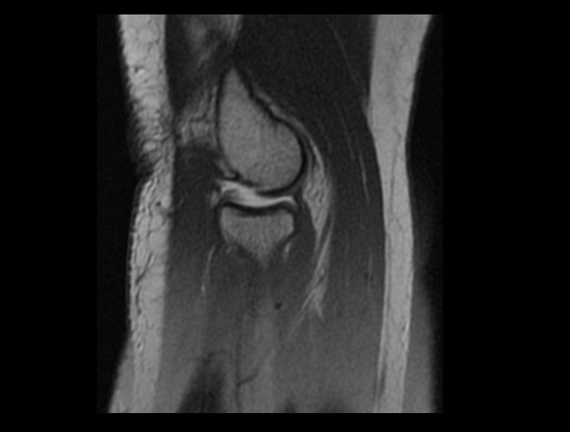 File:Normal elbow arthrograms (Radiopaedia 75550-86805 Sagittal PD 13).jpg