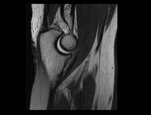 File:Normal elbow arthrograms (Radiopaedia 75550-86805 Sagittal PD 22).jpg